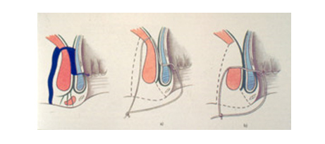 imagem de Fistulectomia